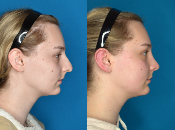 Rhinoplasty Before & After - Dr. Mark A. Clymer - Nashville, TN