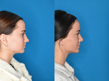 Rhinoplasty Before & After - Dr. Mark A. Clymer - Nashville, TN