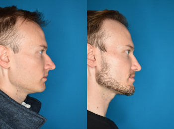 Rhinoplasty Before & After - Dr. Mark A. Clymer - Nashville, TN