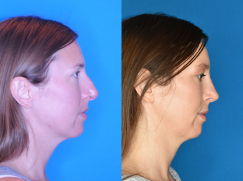 Rhinoplasty Before & After - Dr. Mark A. Clymer - Nashville, TN