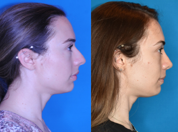 Rhinoplasty Before & After - Dr. Mark A. Clymer - Nashville, TN