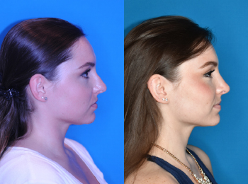Rhinoplasty Before & After - Dr. Mark A. Clymer - Nashville, TN