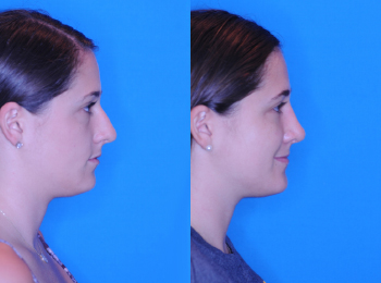Rhinoplasty Before & After - Dr. Mark A. Clymer - Nashville, TN