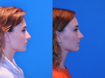 Rhinoplasty Before & After - Dr. Mark A. Clymer - Nashville, TN