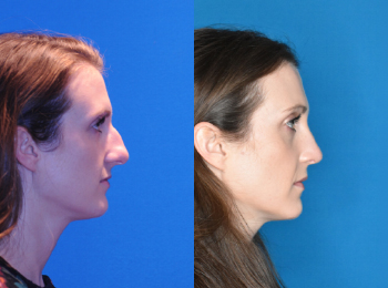 Rhinoplasty Before & After - Dr. Mark A. Clymer - Nashville, TN