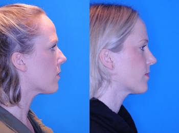 Rhinoplasty Before & After - Dr. Mark A. Clymer - Nashville, TN