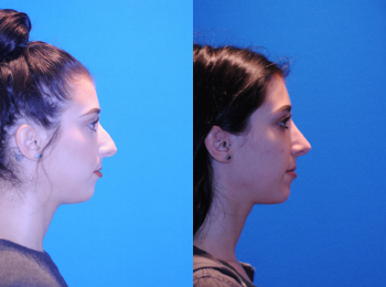 Rhinoplasty Before & After - Dr. Mark A. Clymer - Nashville, TN