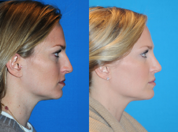 Rhinoplasty Before & After - Dr. Mark A. Clymer - Nashville, TN