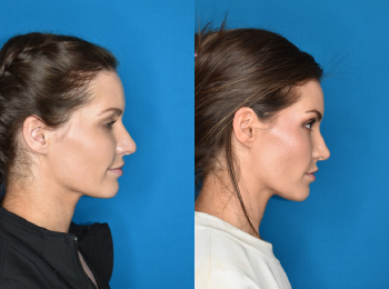 Rhinoplasty Before & After - Dr. Mark A. Clymer - Nashville, TN