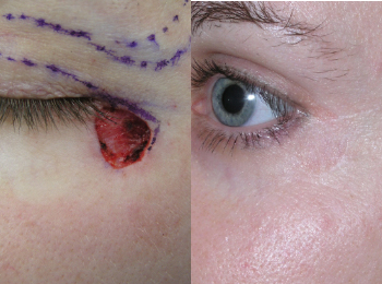 Scar Revision / Reconstruction Before & After - Dr. Mark A. Clymer - Nashville, TN