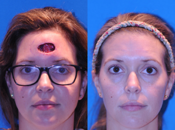 Scar Revision / Reconstruction Before & After - Dr. Mark A. Clymer - Nashville, TN