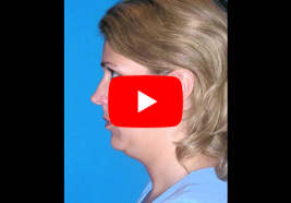 Neck Contouring Video Gallery 1