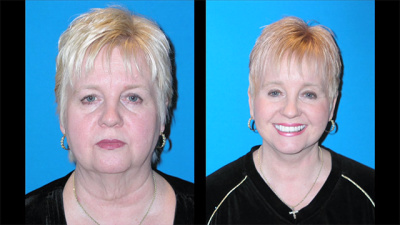 Nashville Facelift and Brow Lift Before and After