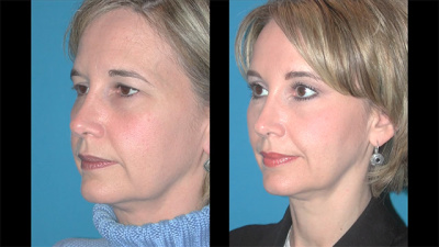 Nashville Brow Lift, Eyelid Lift, Cheek Lift Before and After