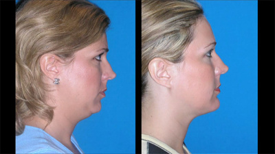 Nashville Neck Contouring Plastic Surgery Before and After