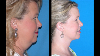 Nashville Facelift and Upper Eyelid Lift Before and After