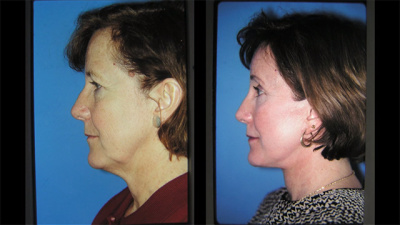 Facelift, Brow Lift, Eyelid Lift, Laser Resurfacing Before and After
