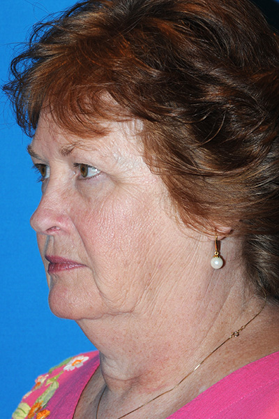 Facelift, Browlift, Upper and Lower Blepharoplasty, Fat Transfer Before Facelift, Browlift, Upper and Lower Blepharoplasty, Fat Transfer Before