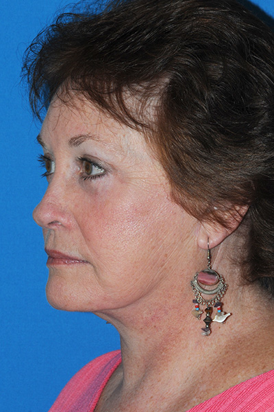 Facelift, Browlift, Upper and Lower Blepharoplasty, Fat Transfer After