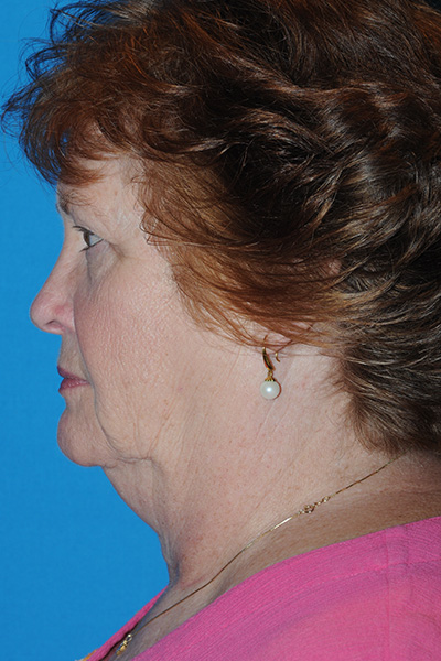 Facelift, Browlift, Upper and Lower Blepharoplasty, Fat Transfer Before
