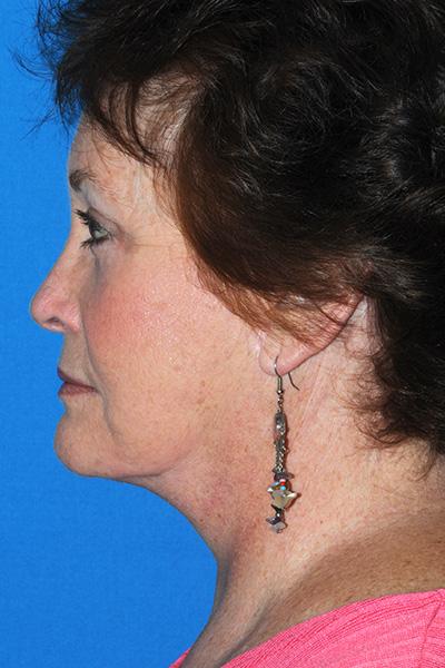 Facelift, Browlift, Upper and Lower Blepharoplasty, Fat Transfer After