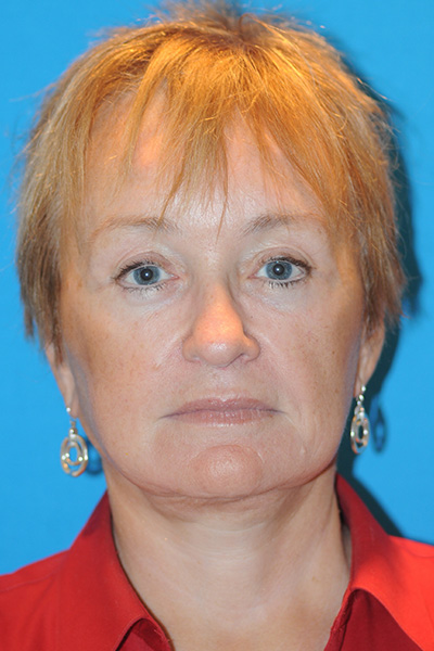 Facelift, Browlift, Upper and Lower Blepharoplasty, Fat Transfer After Facelift, Browlift, Upper and Lower Blepharoplasty, Fat Transfer After