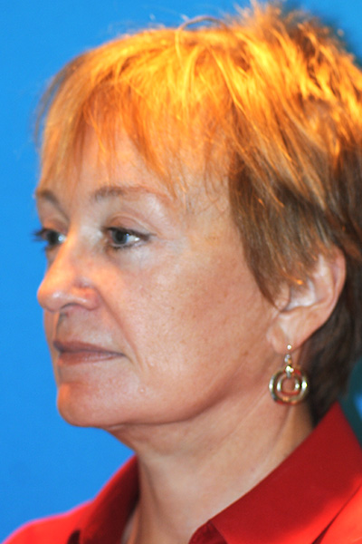 Facelift, Browlift, Upper and Lower Blepharoplasty, Fat Transfer After Facelift, Browlift, Upper and Lower Blepharoplasty, Fat Transfer After