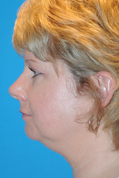 Chin Augmentation, Facelift Before