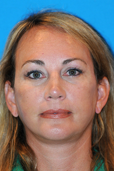 Chin Augmentation, Facelift, Rhinoplasty After Chin Augmentation, Facelift, Rhinoplasty After