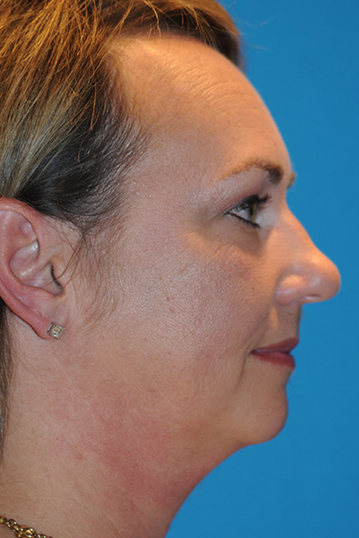 Chin Augmentation, Facelift, Rhinoplasty Before