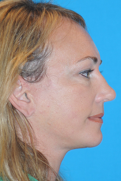 Chin Augmentation, Facelift, Rhinoplasty After Chin Augmentation, Facelift, Rhinoplasty After