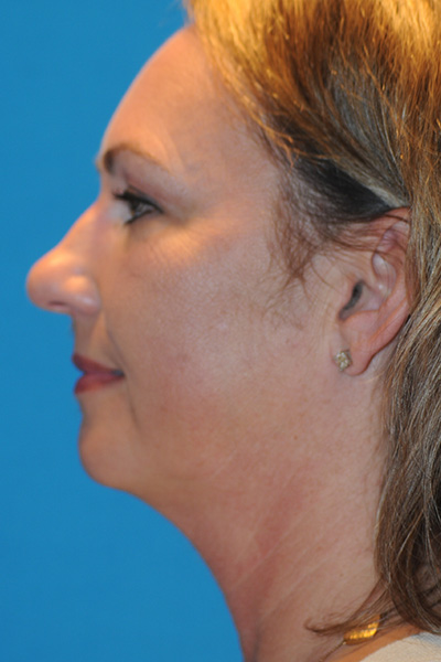 Chin Augmentation, Facelift, Rhinoplasty Before