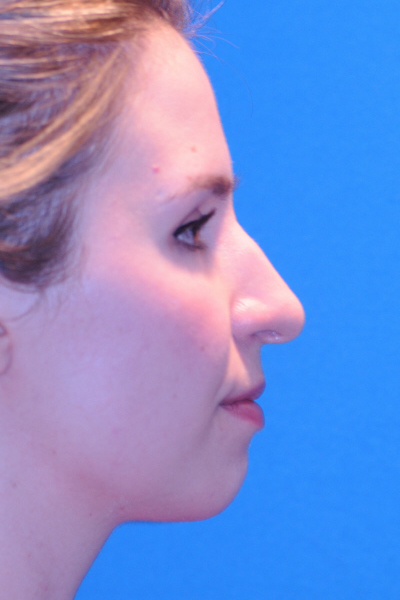 Chin Augmentation, Rhinoplasty Before