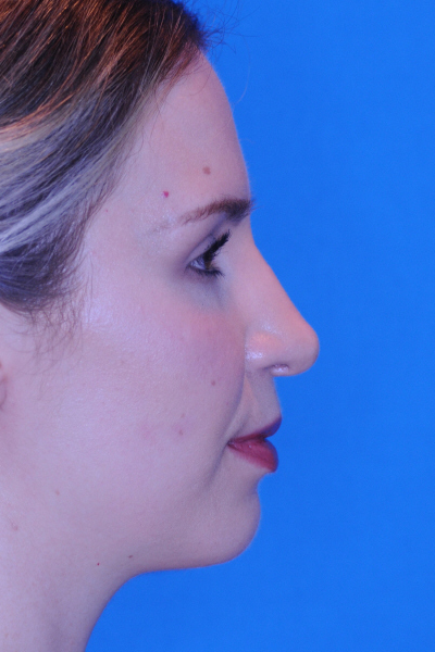 After Chin Augmentation