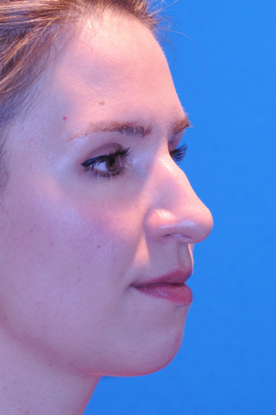 Chin Augmentation, Rhinoplasty Before