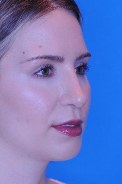 Chin Augmentation, Rhinoplasty After