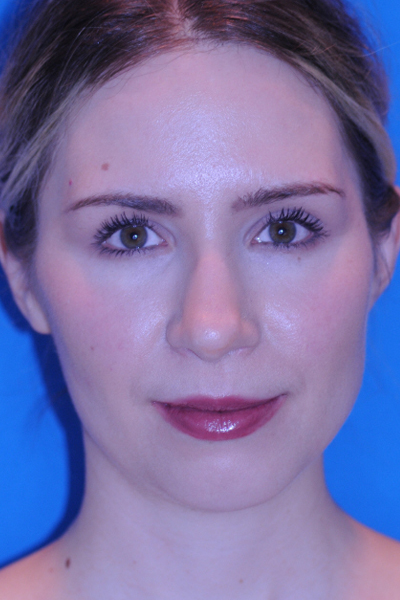 After Chin Augmentation