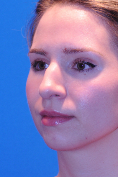 Chin Augmentation, Rhinoplasty Before