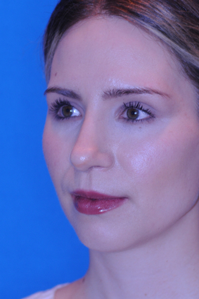 Chin Augmentation, Rhinoplasty After