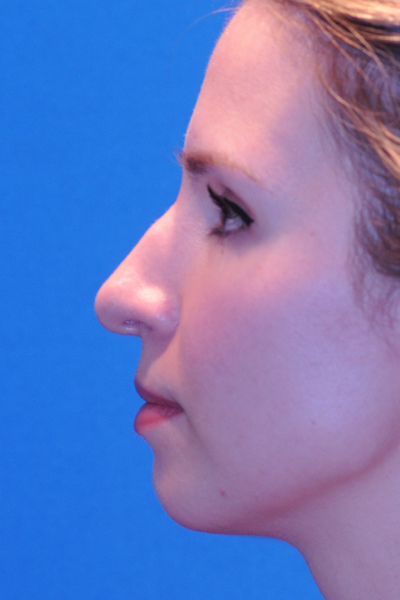 Chin Augmentation, Rhinoplasty Before