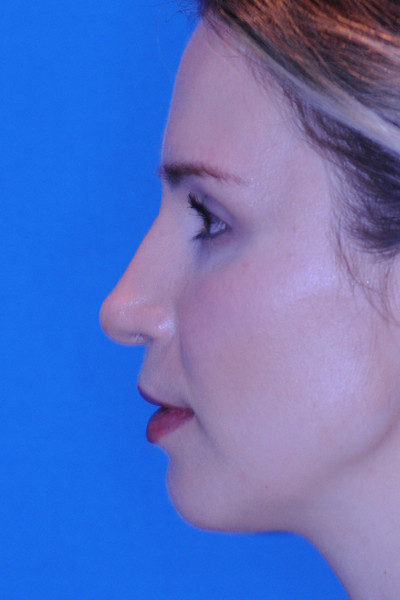 Chin Augmentation, Rhinoplasty After