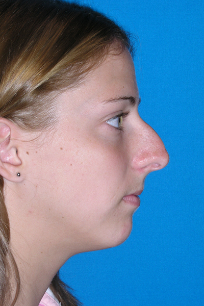 Chin Augmentation, Rhinoplasty Before