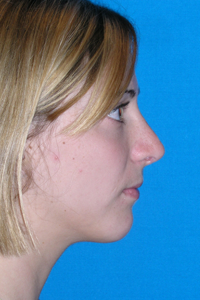 Chin Augmentation, Rhinoplasty After