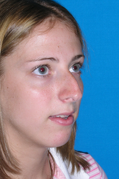 Chin Augmentation, Rhinoplasty Before