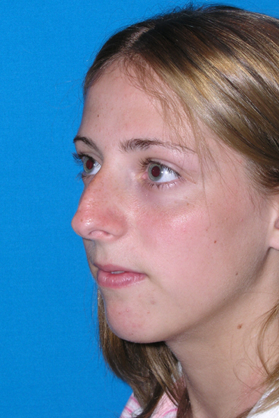 Chin Augmentation, Rhinoplasty Before