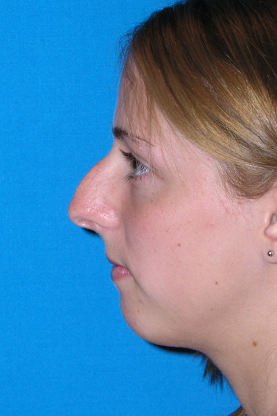 Chin Augmentation, Rhinoplasty Before