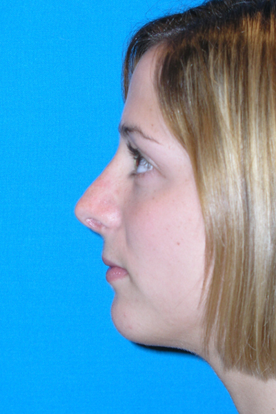 Chin Augmentation, Rhinoplasty After