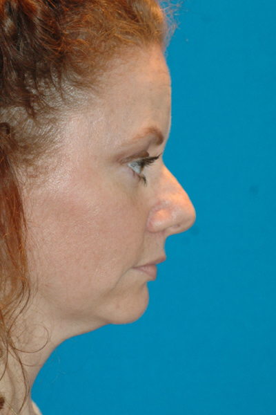 Chin Augmentation, Rhinoplasty Before