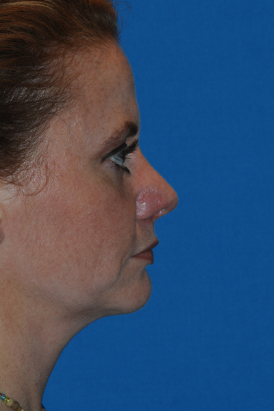 Chin Augmentation, Rhinoplasty After