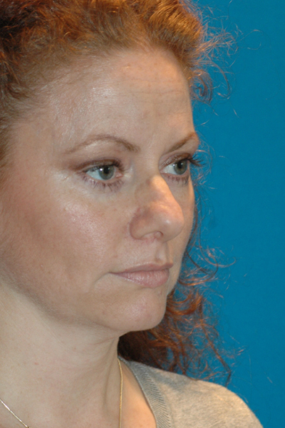 Chin Augmentation, Rhinoplasty Before